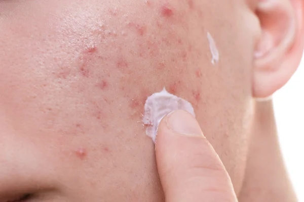 Nakładanie kremu na zmiany trądzikowe.